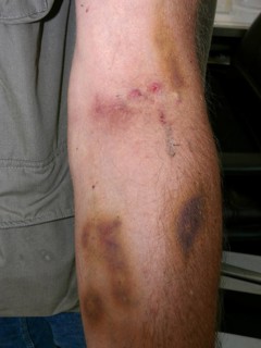 Arms of a junkie