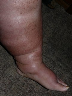 Elephantiasis