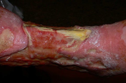 Smoker's leg"" with Squamous-cell carcinoma of the lower leg