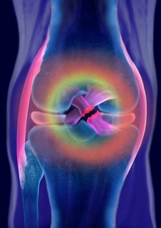 Rupture of a cruciate ligament
