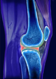 Meniscus