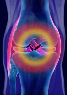 Rupture of both cruciate ligaments