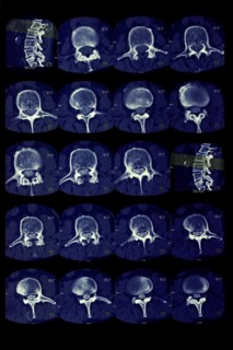 Lumbar vertebrae