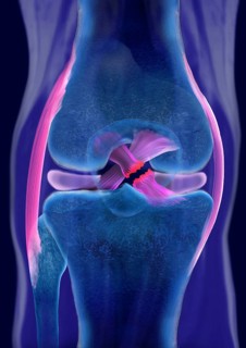 Rupture of a cruciate ligament