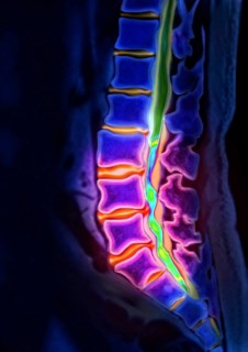 Herniated disk
