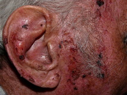 Squamous-cell carcinomas of the face and ear