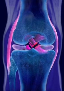 Rupture of both cruciate ligaments
