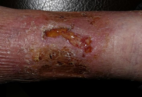 Infected bite wound of the lower leg