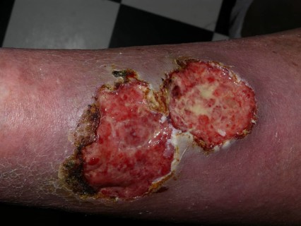 Arteriovenous leg ulcers with super-infection and malignancy