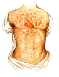 Measles