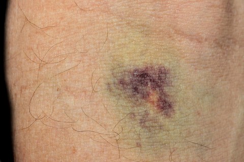 Haematoma after blood sampling