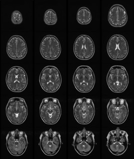 MRT scan