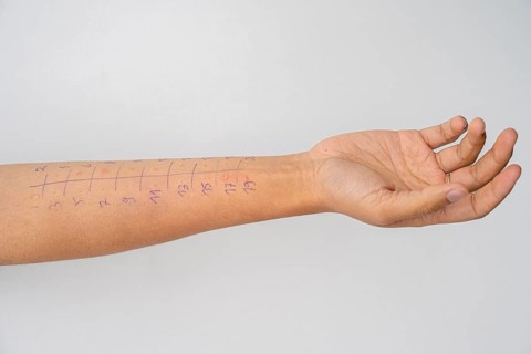 Allergy test