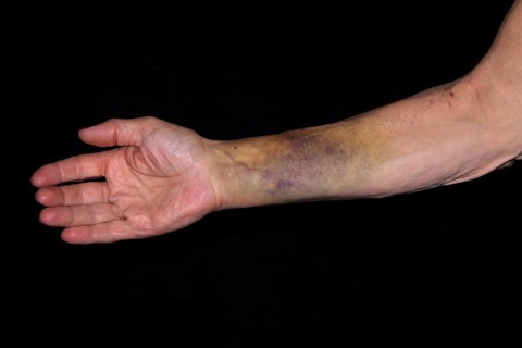 Patient with a bruise