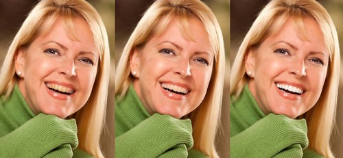 Smiling female showing progressive teeth whitening and bleaching