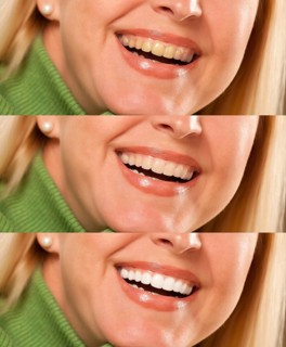 Smiling female showing progressive teeth whitening and bleaching