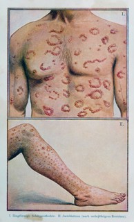Annular psoriasis and itching patches