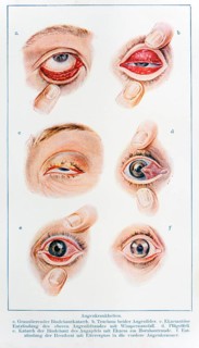 Various eye diseases