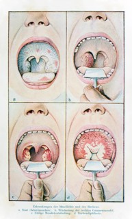 Diseases of the oral cavity