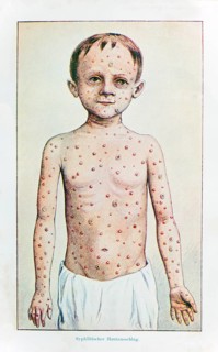 Skin rashes in syphilis
