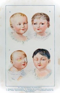 The eye diseases in children