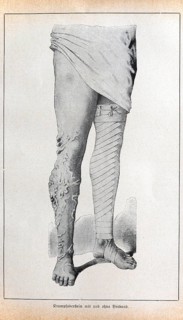 Varicose veins (varicosis) with and without bandages