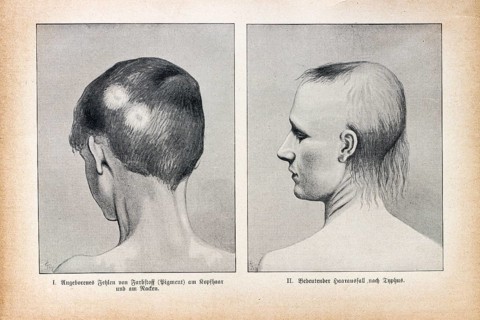 Absence of dye on the hair of the head and significant hair loss after typhoid fever