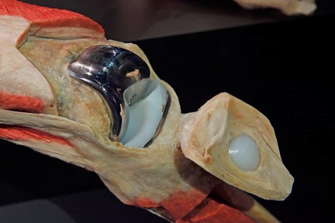 Artificial knee joint