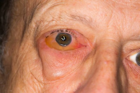 Infectious conjunctivitis