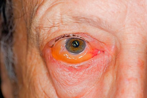 Infectious conjunctivitis