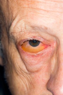 Infectious conjunctivitis