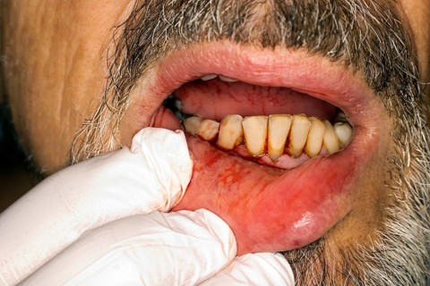 Symbolic image for periodontitis