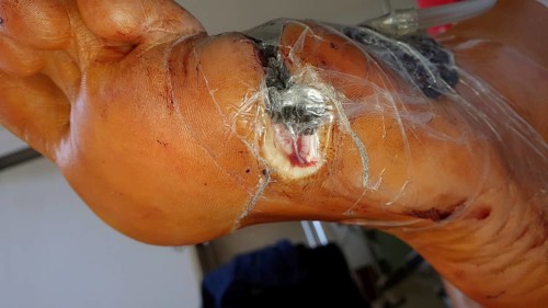 Vacuum therapy after surgery for diabetic foot syndrome