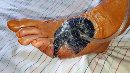 Vacuum therapy after surgery for diabetic foot syndrome