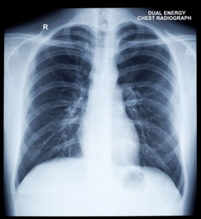 X-Ray Image Of Human Healthy Chest