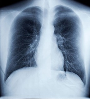 X-Ray Image Of Human Healthy Chest