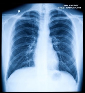 X-Ray Image Of Human Healthy Chest
