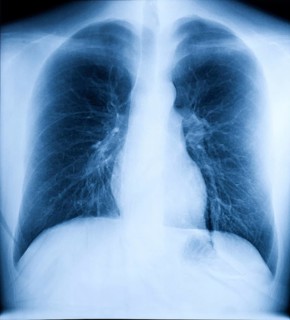 X-Ray Image Of Human Healthy Chest