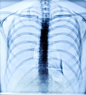 X-Ray Image Of Human Healthy Chest