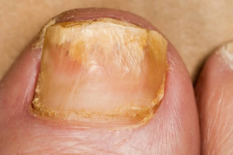 Nail fungus