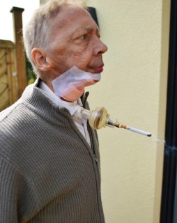The Mother Theresa Hospice offers its guests a dignified home in a new friendly ambience for the patients in their last stage of life. This patient with carcinoma of the floor of the mouth caused by s...