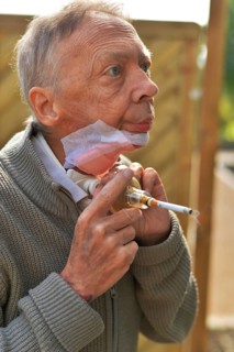 The Mother Theresa Hospice offers its guests a dignified home in a new friendly ambience for patients in their last phase of life. This patient with carcinoma of the floor of the mouth caused by smoki...