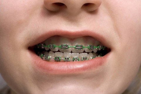 Dental Braces