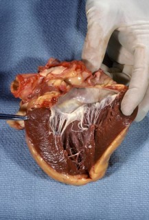 Human heart showing the endocardium & myocardium w/ mitral valve