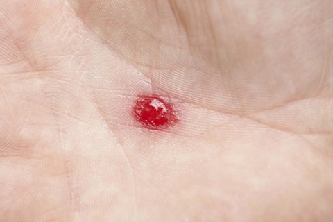 Blood on a palm