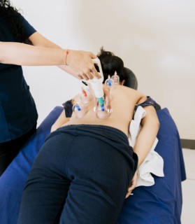 Physiotherapist Applying Cupping Techniques on patient