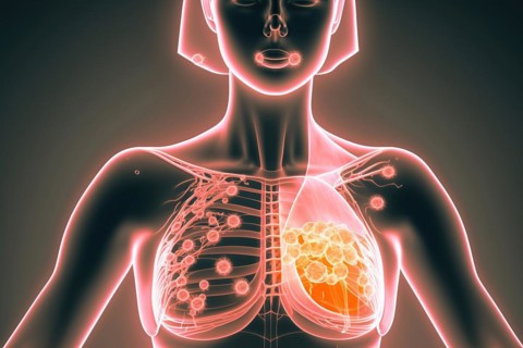 Schematic representation of metastatic breast cancer