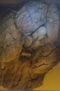 Human brain embalmed in a glass jar