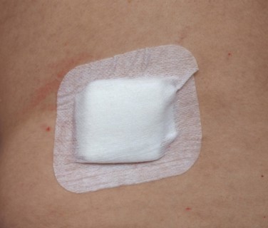 Antibacterial woundpad island dressing