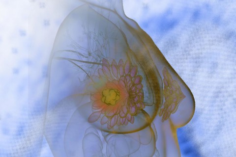 Breast cancer This type of cancer is very common in woman